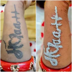 Here is a direct comparison showing a client's forearm tattoo before treatment and immediately after one session. The white frosting indicates the laser has successfully shattered the ink particles beneath the skin, starting the natural fading process.
