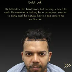 For years, Aman struggled with a bald look and had lost hope after trying different treatments. He came to us seeking a permanent solution, and this photo shows the first step: mapping out a new hairline to restore his confidence.