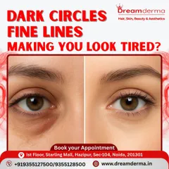 Tired-looking eyes can be refreshed. This before and after comparison demonstrates our expertise in treating dark circles and fine lines. Our targeted approach restores brightness and youthfulness to the delicate under-eye area, helping you look as rested and vibrant as you feel.