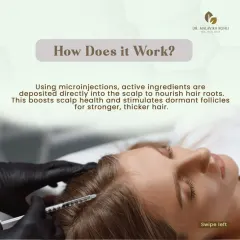 This image details the mechanism of Hair Mesotherapy. Using microinjections, I deposit a customized blend of active ingredients directly into the scalp to nourish hair roots, boost scalp health, and stimulate dormant follicles for stronger, thicker hair.