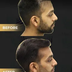 A bad hair transplant can be devastating. This is a corrective procedure we performed to fix a previous, poorly done transplant from another clinic. Using 3500 grafts with our Perfect-i technique, we were able to create the natural, dense result the patient originally wanted.