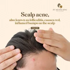 Scalp acne, clinically known as folliculitis, presents as red, inflamed bumps on the scalp. It is an inflammatory condition of the hair follicles that requires a specific diagnosis and treatment approach.