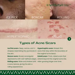 This guide illustrates the primary types of acne scars I treat. It is important to distinguish between atrophic scars like ice pick, boxcar, and rolling types, which are depressions in the skin, and hypertrophic or keloid scars, which are raised. Each requires a different therapeutic strategy for optimal results.