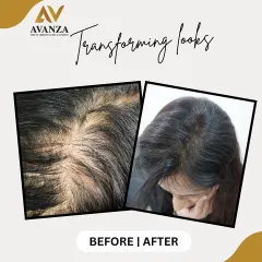 A detailed look at how we tackle hair thinning at the parting. This before and after comparison shows a significant improvement in hair density, effectively covering the scalp and creating a much fuller appearance.