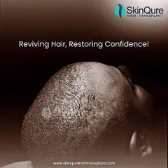 Reviving hair is about more than just surgery; it's about restoring confidence. This image captures the essence of my work: creating a dense, natural-looking result that allows my patients to feel like themselves again.