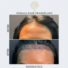 Hair loss affects women too, and a transplant can be a fantastic solution. This before-and-after shows a female hair transplant 10 days post-procedure, where 2200 grafts were used to create a fuller, lower hairline.