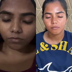 A powerful before and after from my Korean Whitening Treatment. This client came to me with significant tanning and uneven skin tone on her forehead. The after photo shows a dramatically brighter, more even complexion and that signature glass skin glow.