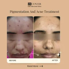 This before-and-after image shows the results of our pigmentation and acne treatment plan. With a combination of in-clinic procedures and a proper home care routine, we achieved significant clearing and a more even skin tone.