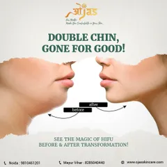 A defined jawline can transform your profile. Here you can see a clear before and after result of using non-surgical HIFU treatment to reduce a double chin. This procedure uses ultrasound to tighten the skin and melt fat, creating a sharper, more contoured look without any surgery.