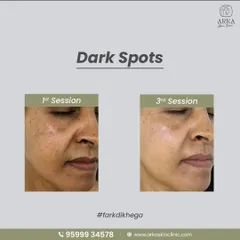 Here is a clear example of "Fark Dikhega." This patient saw a significant reduction in dark spots and pigmentation after just a few sessions. Consistency and the right treatment plan are key.