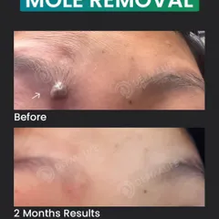 Here you can see the result just two months after a surgical mole removal. My technique focuses on complete removal with precision to ensure the mole does not return and to leave behind the most minimal scar possible. The final result is clear, smooth skin.