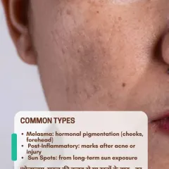 Not all dark spots are the same. This image explains the common types of hyperpigmentation, including hormonal melasma, post-inflammatory marks from acne, and sun spots from long-term sun exposure.
