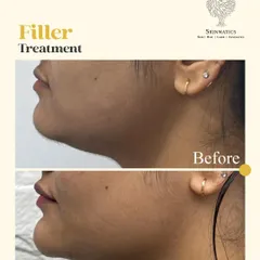A defined chin can significantly improve facial balance. This before-and-after demonstrates the immediate impact of a chin filler treatment, creating a sharper and more elegant profile.