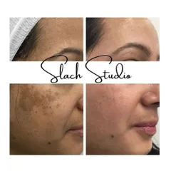 This result showcases the power of the Korean Glass Skin treatment on stubborn pigmentation and uneven skin tone. Notice the significant lightening of dark patches on the cheeks and forehead, revealing a much brighter and more uniform complexion.