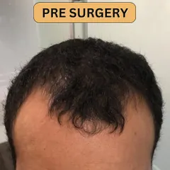 This is the 'before' state, showing the area of hair loss prior to the procedure. A clear baseline is important for tracking progress.