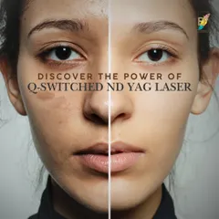This visual demonstrates the power of the Q-Switched ND YAG laser for pigmentation correction. By targeting melanin at its source, this treatment effectively fades issues like melasma and stubborn dark spots, leading to a clearer and more even-toned complexion.