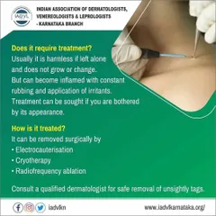 An informational post detailing the professional treatment options for skin tags. We explain that while often harmless, removal can be done via methods like electrocauterisation or radiofrequency ablation for cosmetic reasons.