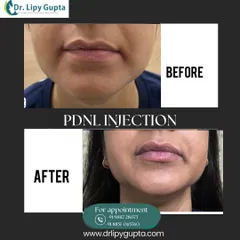 This before-and-after shows the subtle but impactful result of a PDNL injection. This treatment helps improve lip hydration and elasticity, reducing fine lines and creating a healthier, plumper appearance.