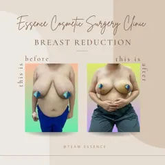 A straightforward before-and-after of a breast reduction surgery. The 'after' photo clearly shows a significant decrease in breast volume, resulting in a more proportionate and comfortable chest for the patient.