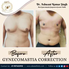 This before and after image highlights the transformative effect of gynecomastia surgery. The post-surgery photo shows a well-defined, flatter chest, restoring a natural and masculine contour.