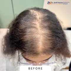 This is the 'before' photo of a patient experiencing significant thinning at the crown and a wide partition. This is a typical presentation of female pattern hair loss that I frequently treat at my clinic.