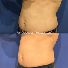 Another angle demonstrating the successful fat loss in the abdominal area. Notice the improved contour and flatter profile. This is not just weight loss; it is a strategic reduction of fat for a healthier, stronger physique.