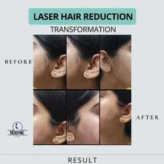Unwanted facial hair can be a source of constant worry. This before and after collage shows the significant reduction of hair on the sideburns and cheeks, resulting in clearer, smoother skin and renewed confidence.