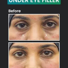 A frontal view showcasing the immediate results of an under-eye filler treatment. Notice how the hollowness beneath both eyes is visibly reduced, creating a smoother and more rested appearance right after the procedure.