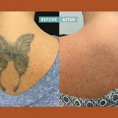 A powerful before-and-after image showcasing the complete removal of a large butterfly tattoo from a patient's back, demonstrating the effectiveness of our laser tattoo removal process.
