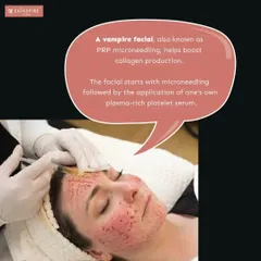 A closer look at the PRP microneedling process. While it may look intense, the procedure is performed carefully in a sterile clinical environment to ensure safety and maximize results for smoother, healthier skin.