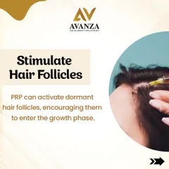 This is a close-up of our Platelet-Rich Plasma (PRP) therapy in action. The procedure uses concentrated growth factors from your own blood, which are carefully injected into the scalp to activate dormant hair follicles and encourage them to enter the growth phase.