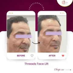 This is a perfect example of what a thread facelift can achieve. You can see a clear, yet natural-looking lift and improved contour in the 'after' photo. We achieved this without surgery by using dissolvable threads to lift sagging skin and stimulate collagen.