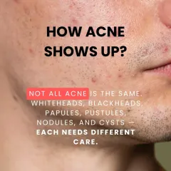 Not all acne is the same. Whiteheads, cysts, and nodules each require a different treatment approach. As a dermatologist, I correctly identify the type of acne to ensure the treatment is effective and prevents long term skin texture changes.