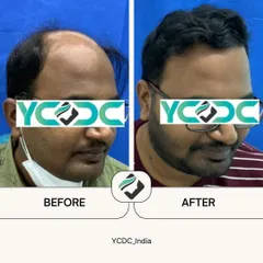 This patient's result after six months demonstrates a remarkable change in hair density and hairline definition. The FUE technique allows for such natural and impressive outcomes.