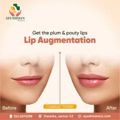 A subtle enhancement can make a significant difference. This before and after demonstrates how we use lip augmentation with dermal fillers to create fuller, more defined lips that look both plump and natural.