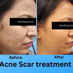 This before and after image shows the significant reduction of acne scars after a few sessions of Microneedling Radiofrequency (MNRF). This procedure helps rebuild collagen and smooths out skin texture, effectively treating deep-pitted scars for a clearer complexion.