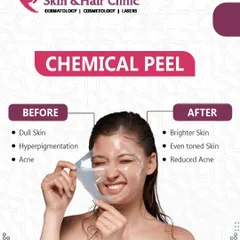 A chemical peel can transform dull skin, hyperpigmentation, and acne into a brighter, even-toned, and clearer complexion. This image shows the peeling process, revealing renewed skin underneath.
