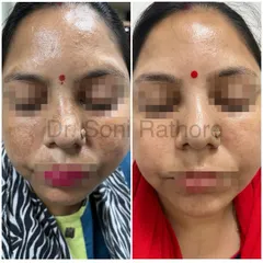 This front-facing before and after shows a dramatic improvement in facial melasma. A consistent, multi-modal treatment plan is the most effective way to manage this stubborn condition.
