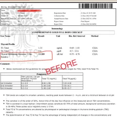 Here is a "before" report showing a patient's Thyroid Stimulating Hormone (TSH) level at 13.285, which is significantly elevated and indicates hypothyroidism.