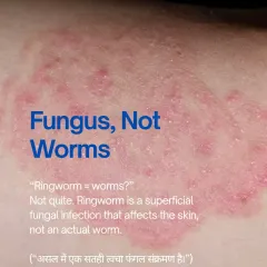 Despite its name, "ringworm" has nothing to do with worms. It is a superficial fungal infection of the skin. Correctly identifying it as a fungus is the first step to the right treatment.