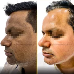 This side profile demonstrates the effectiveness of our pigmentation treatment in reducing dark patches and improving overall skin texture for a healthier appearance.