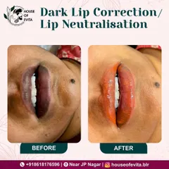 This before-and-after shows the process of Dark Lip Correction. The "after" shows the neutralizing pigment immediately after application, which will heal to a soft, natural tone.