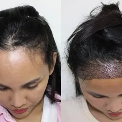 A top-down view showing the area of thinning before and the densely packed grafts immediately after the procedure. This is the first step towards a fuller, lower hairline.