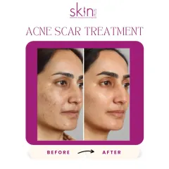 This before-and-after image highlights the success of my targeted acne scar treatments. You can see a dramatic improvement in skin smoothness and a reduction in the depth and discoloration of scars.