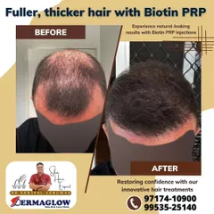 Another example of a successful Biotin PRP treatment. This client experienced a visible increase in hair coverage and thickness across the top of his scalp, restoring his confidence without surgery.