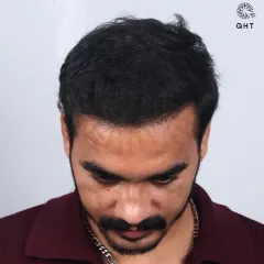 A complete 10-month transformation for a Diffuse Grade 5A case. We recreated the hairline and added density to the frontal and mid-scalp with 3,800 grafts.
