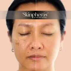 Here you can see a dramatic improvement in skin clarity. My treatments effectively target patches of pigmentation, breaking them down to reveal the brighter, more uniform skin underneath.