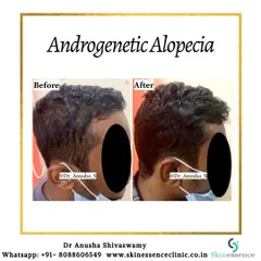 Here is a clear example of treating androgenetic alopecia, focusing on a receding hairline. The 'after' photo shows a noticeable restoration of the hairline and increased thickness in the temple area, achieved through a personalized treatment plan.