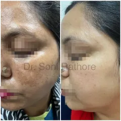 This side profile highlights the successful treatment of widespread melasma. Consistency with both in-clinic procedures and at-home care is the key to managing this challenging skin condition.