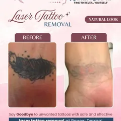 A real result after a few laser tattoo removal sessions. This client's dark feather tattoo has faded significantly. This is a great example of the progress you can expect on your journey to clear skin.